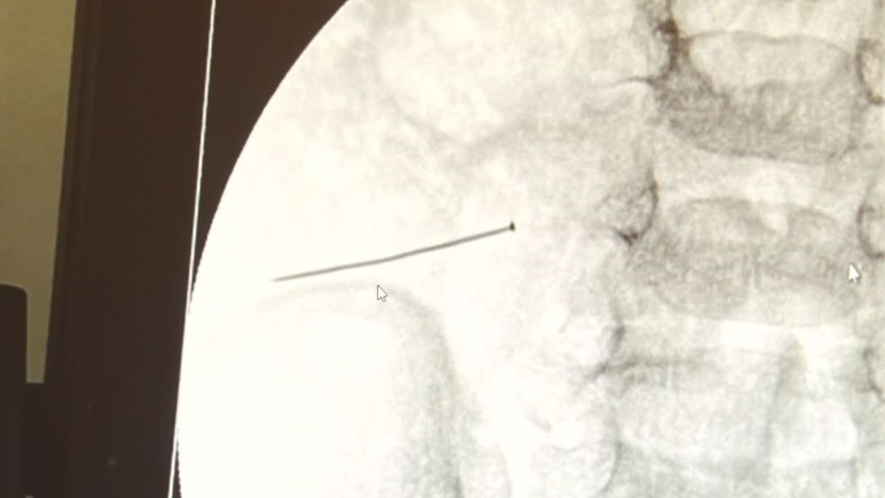 Ağrıyla kıvranan 2 yaşındaki çocuğun bağırsağından 3 santimlik iğne çıktı