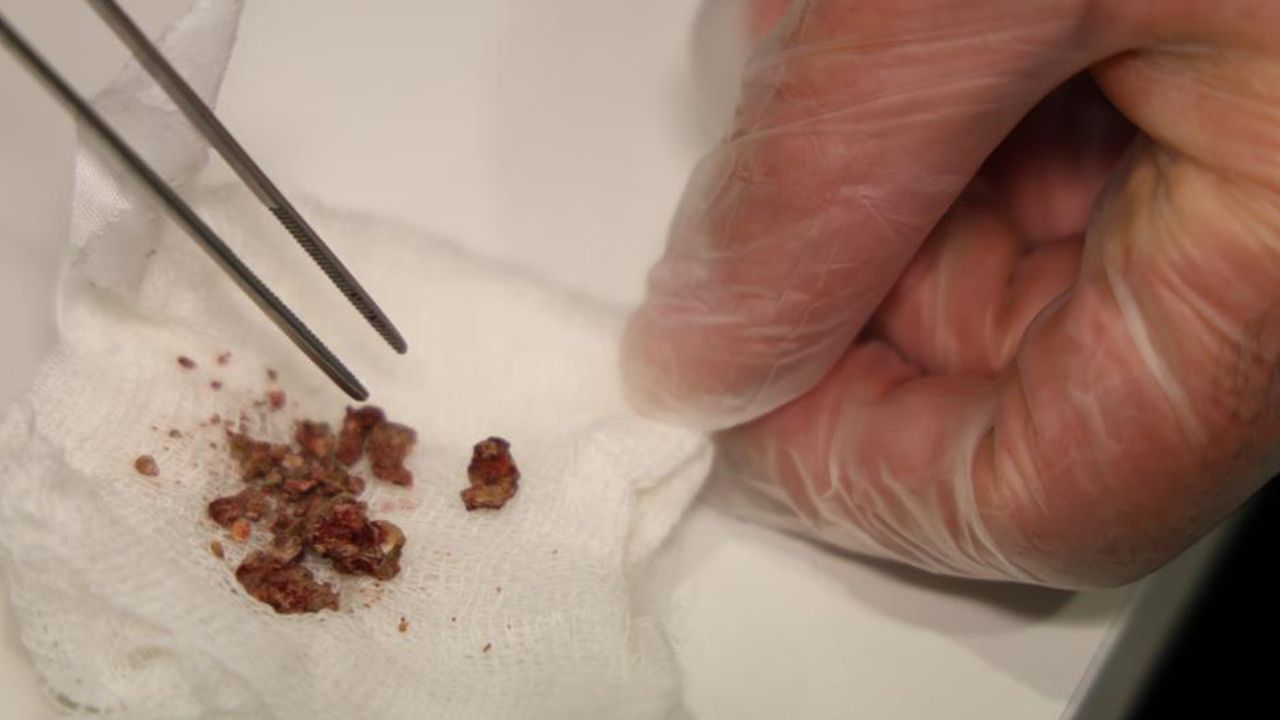 Estetik ameliyatında beklenmeyen keşif: Burnunda taş oluştuğu ortaya çıktı