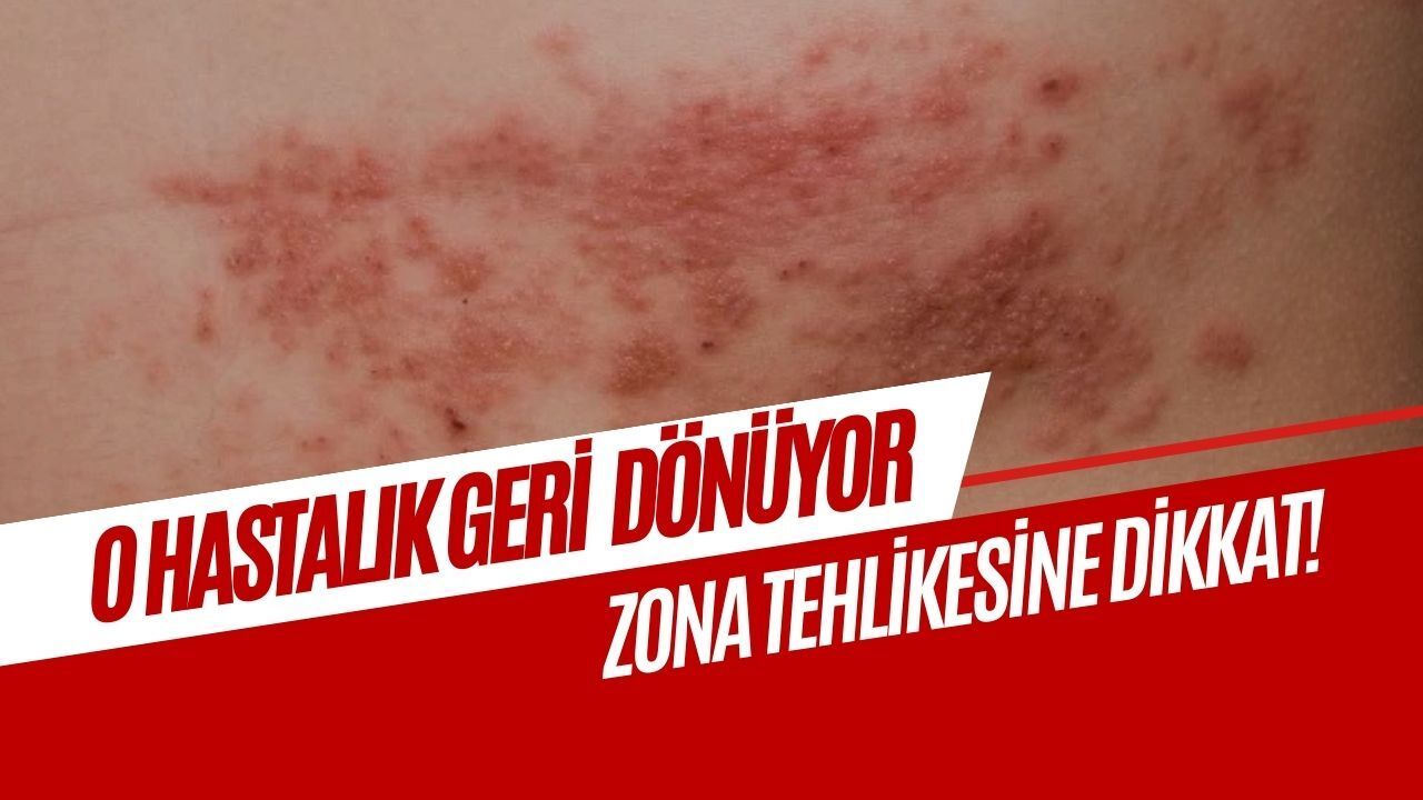 Sessiz kalan virüs geri dönüyor: Zona tehlikesine dikkat!