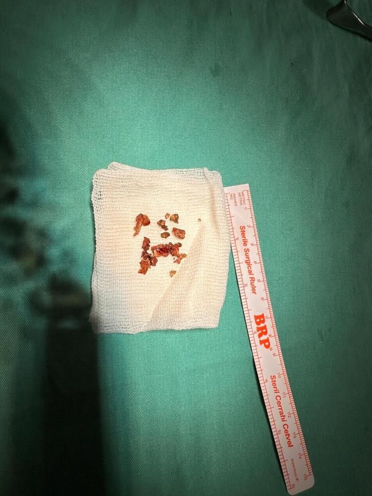 Elazığ’da Estetik Ameliyatta Şaşırtan Olay, Burundan Taş Çıktı 4